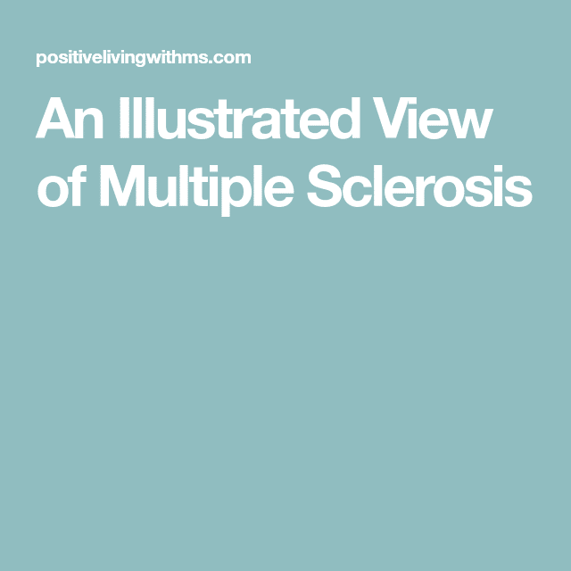 An Illustrated View of Multiple Sclerosis
