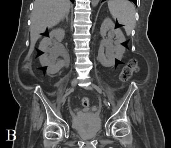 An Unusual Case of Septic Shock from a Urinary Tract Infection