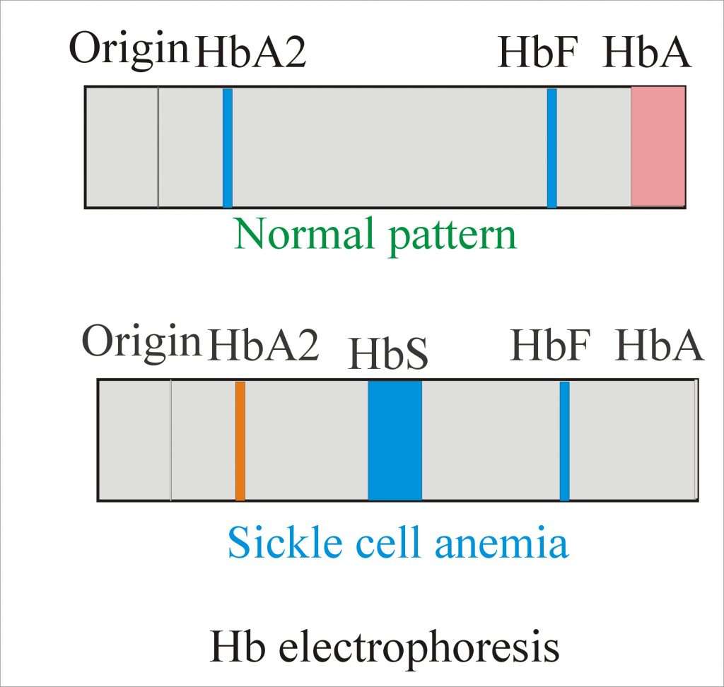 Anemia  Part 5  Sickle Cell Screening (Hemoglobin S ...