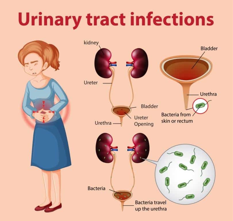 Are Uti And Kidney Infection The Same