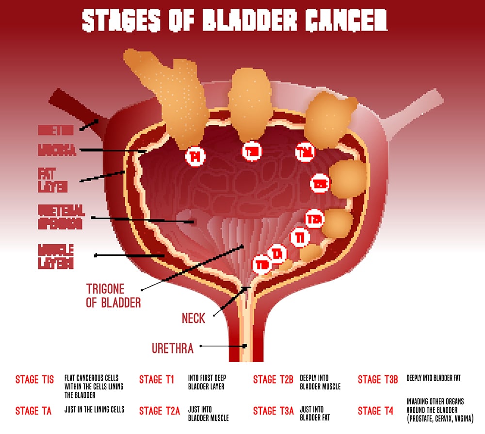 Bladder Cancer Image