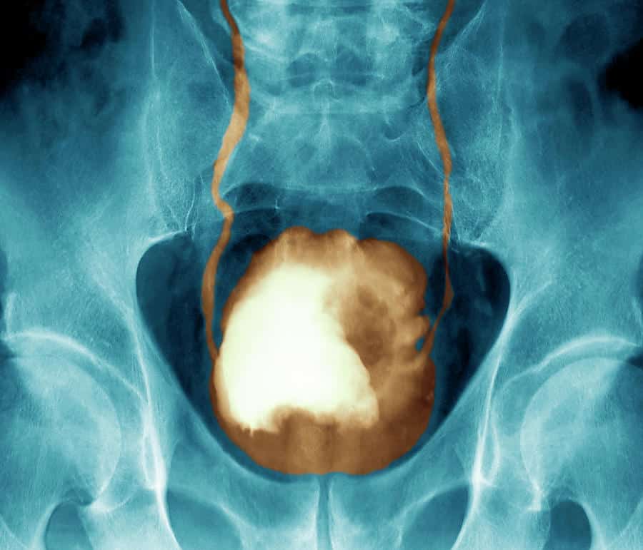 Bladder Cancer Photograph by Zephyr/science Photo Library