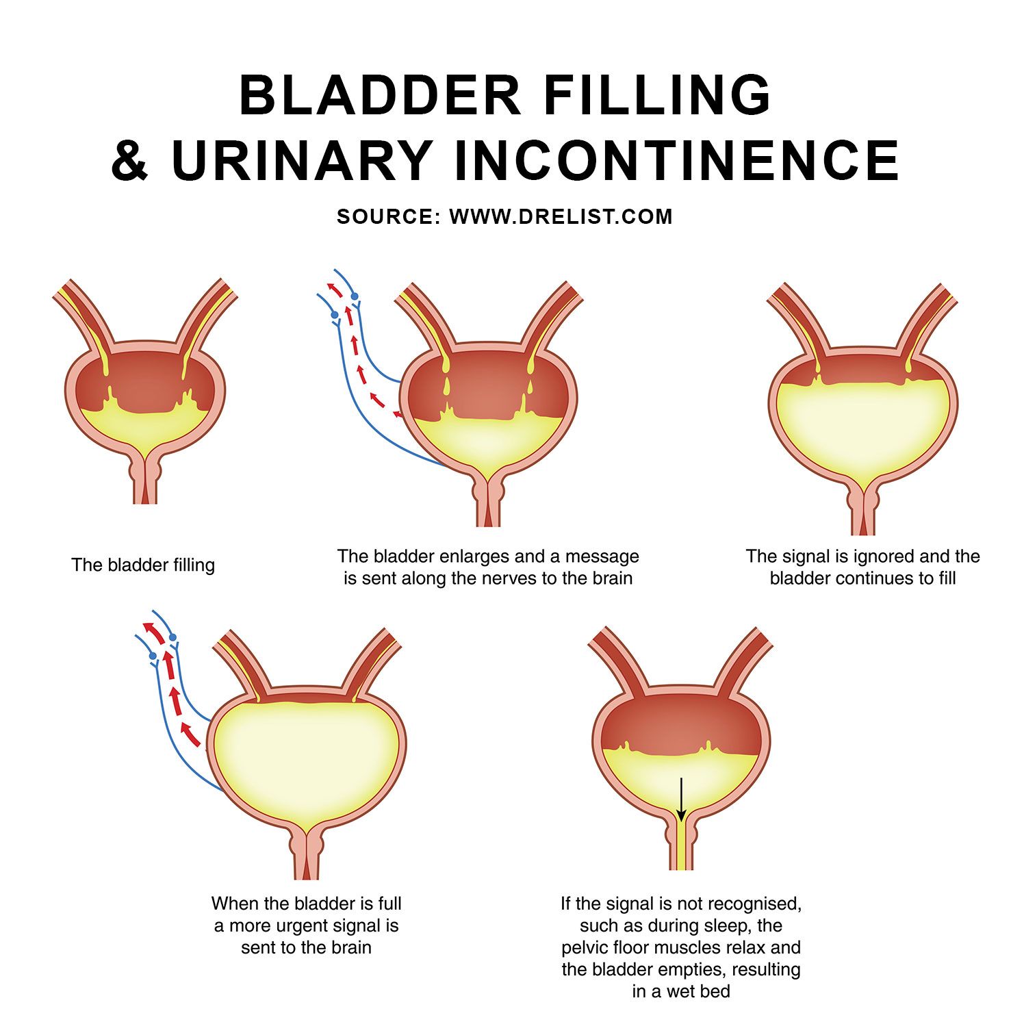 Bladder Filling and Urinary Incontinence Learn more about types of ...