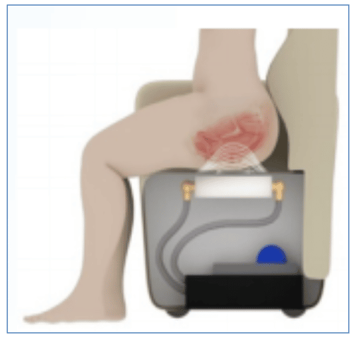 BTL EMSella for Urinary Incontinence