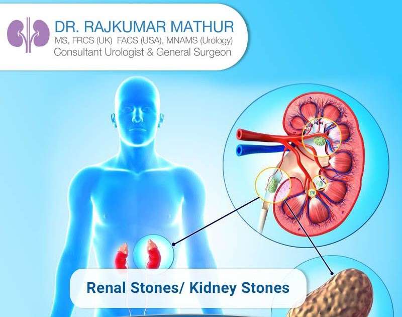 Can Kidney Stones Cause Urinary Incontinence