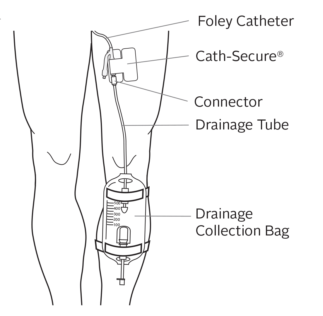 Caring for Your Urinary (Foley) Catheter