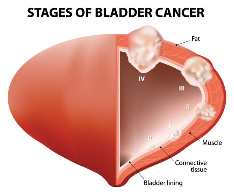 Common Symptoms of Bladder Cancer