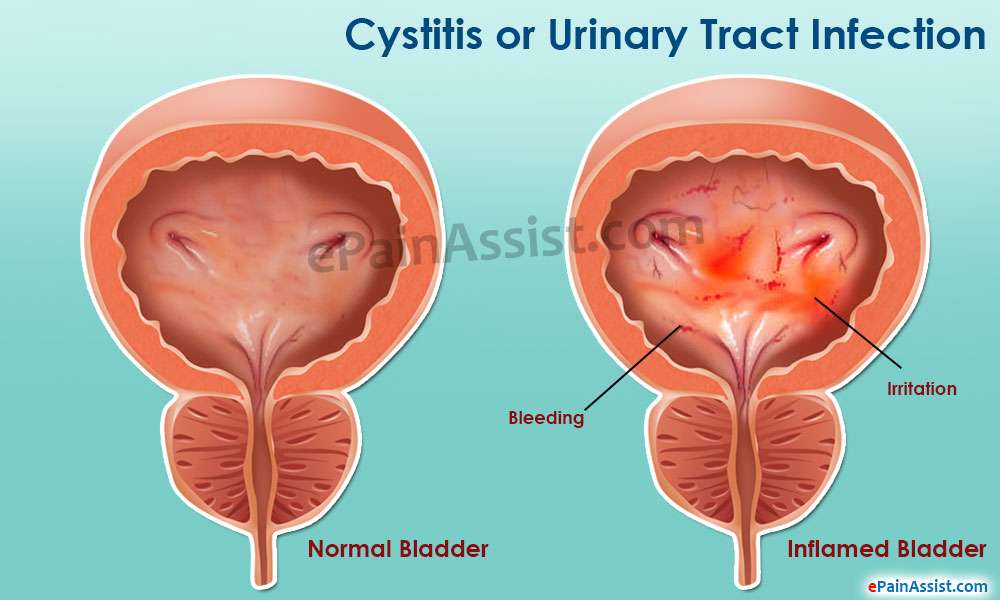 Cystitis or Urinary Tract Infection (UTI)