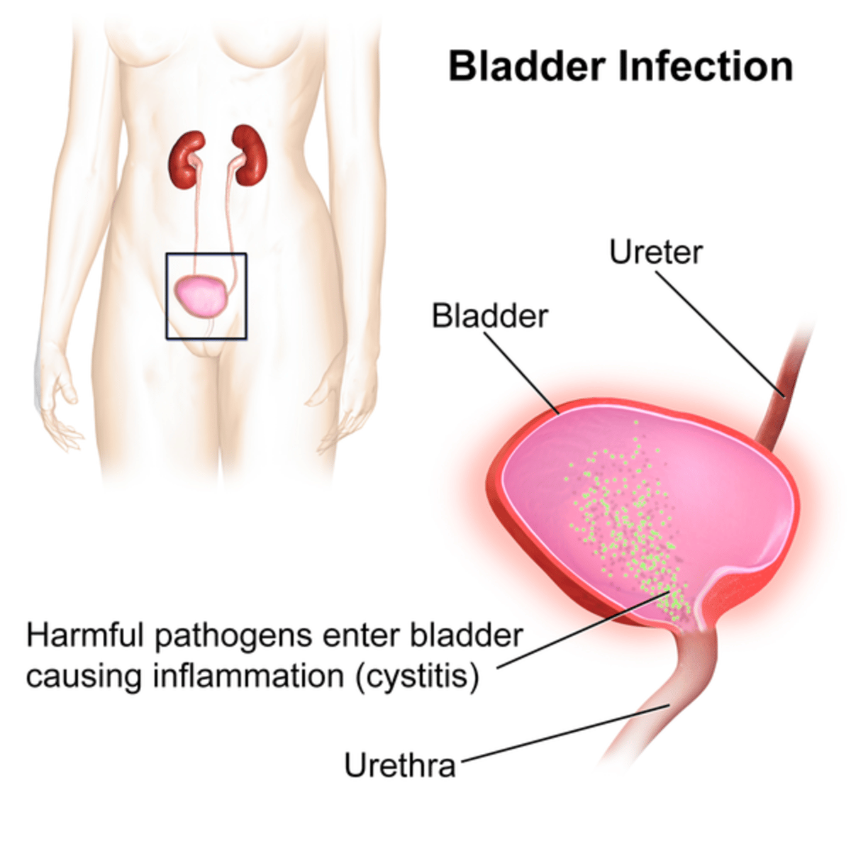 Daily Habits to Prevent Urinary Tract Infections