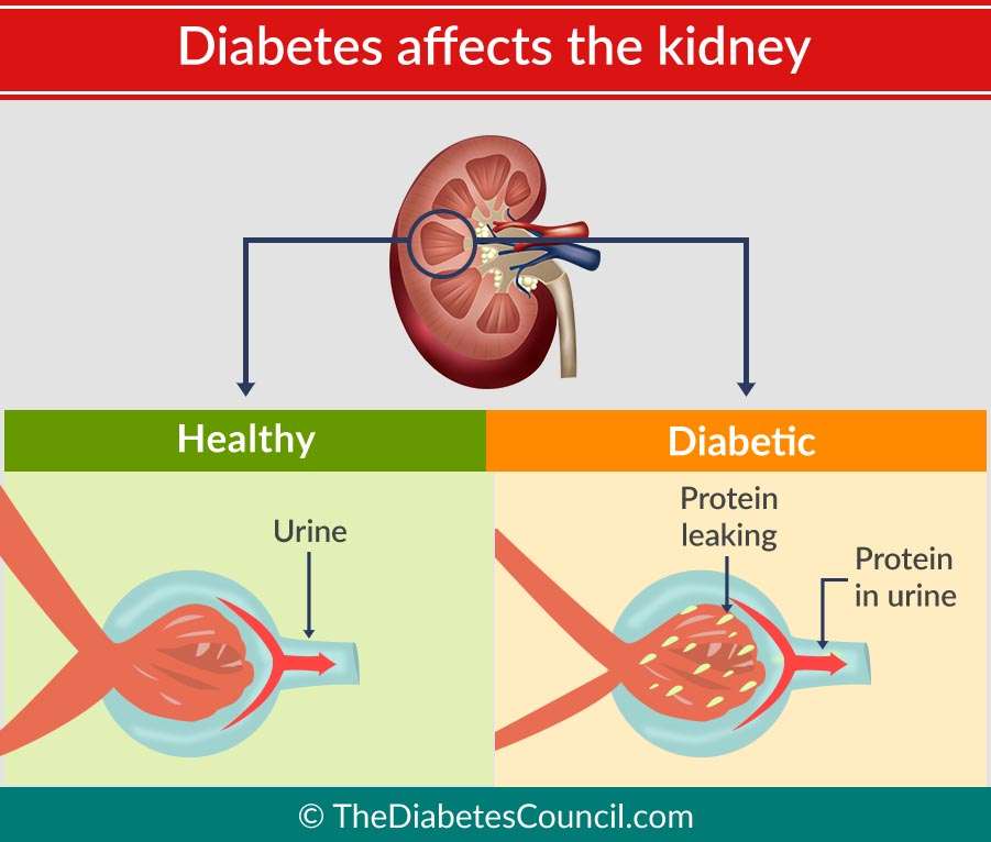 Diabetes And Renal Failure: Everything You Need To Know