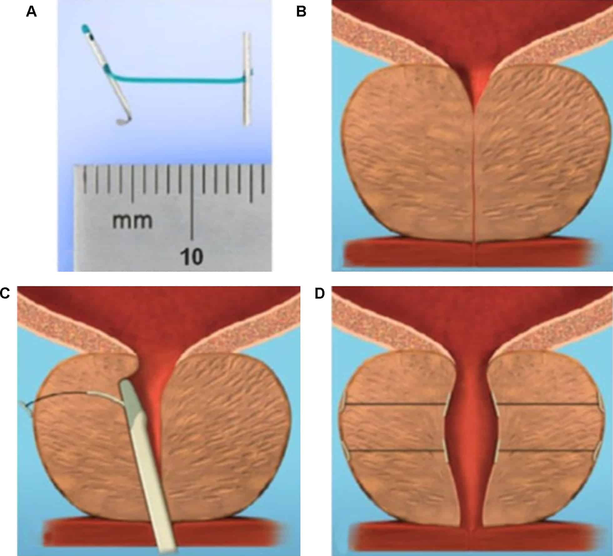 Emerging Minimally Invasive Treatment Options for Male Lower Urinary ...