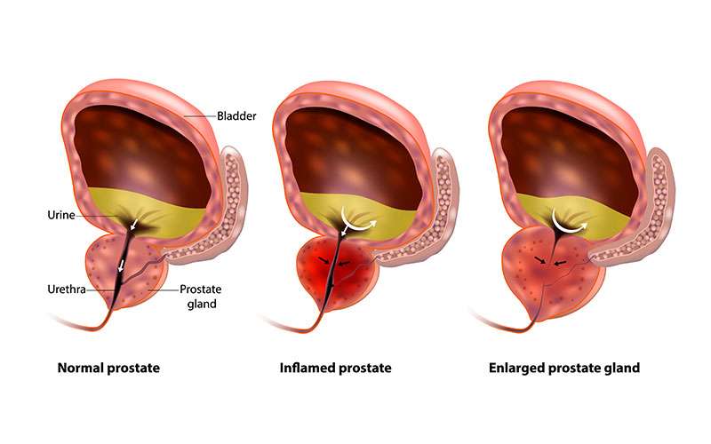 Enlarged Prostate â Chennai