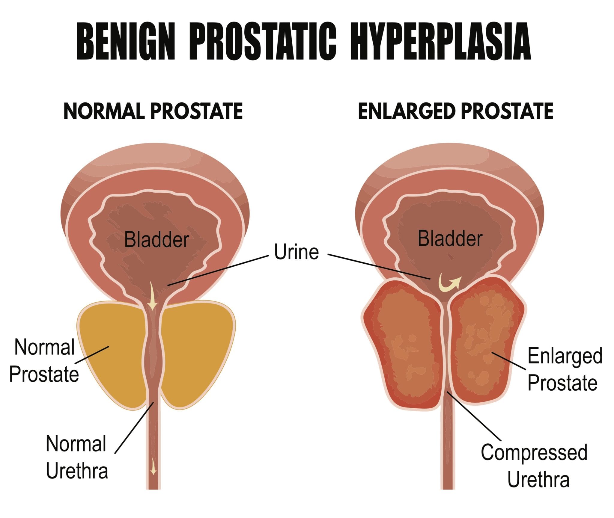 Enlarged Prostate Treatment Chattanooga TN