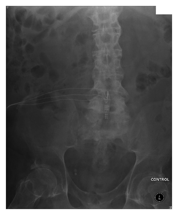 Failure of Urological Implants in Spinal Cord Injury Patients due to ...
