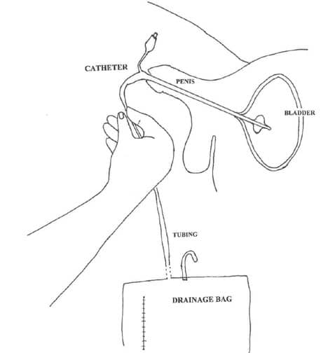 Foley Catheter Causes, Symptoms, Treatment