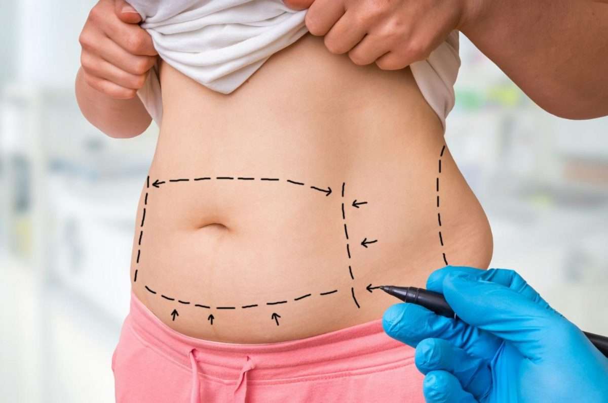 Getting a Tummy Tuck? 8 Things You Should Know Before You Do