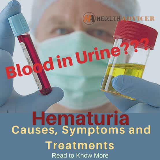 HEALTH GIST: âBLOODYâ? URINE WITHOUT PAIN