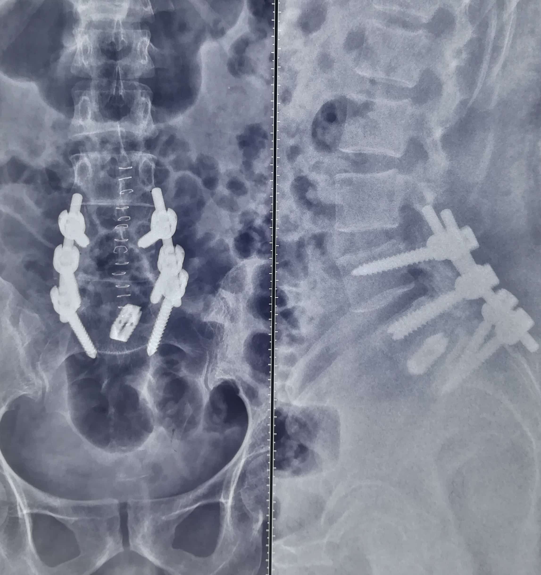 High Grade Spondylolisthesis and Cauda Equina Syndrome A 43 year old ...