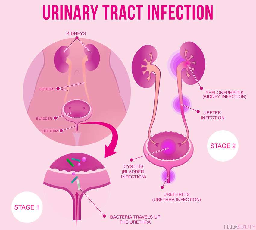 Home Remedies to Relieve UTI (Urinary Tract Infection)