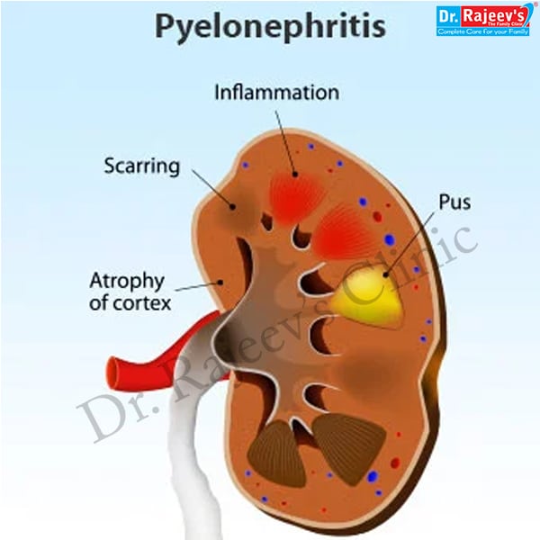 Homeopathic Treatment for Pyelonephritis, Treatment of Pyelonephritis