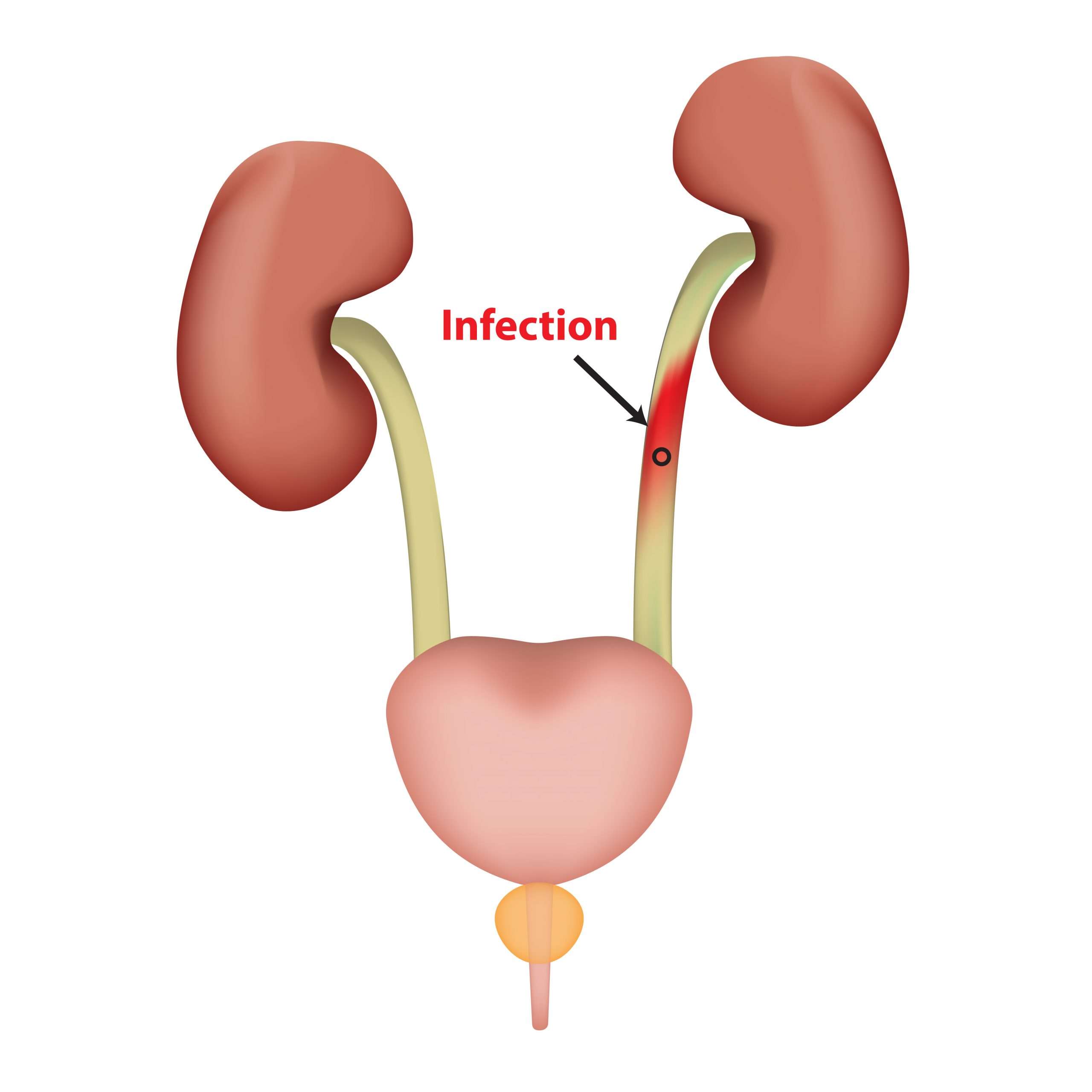 How Can A Male Get A Urinary Tract Infection