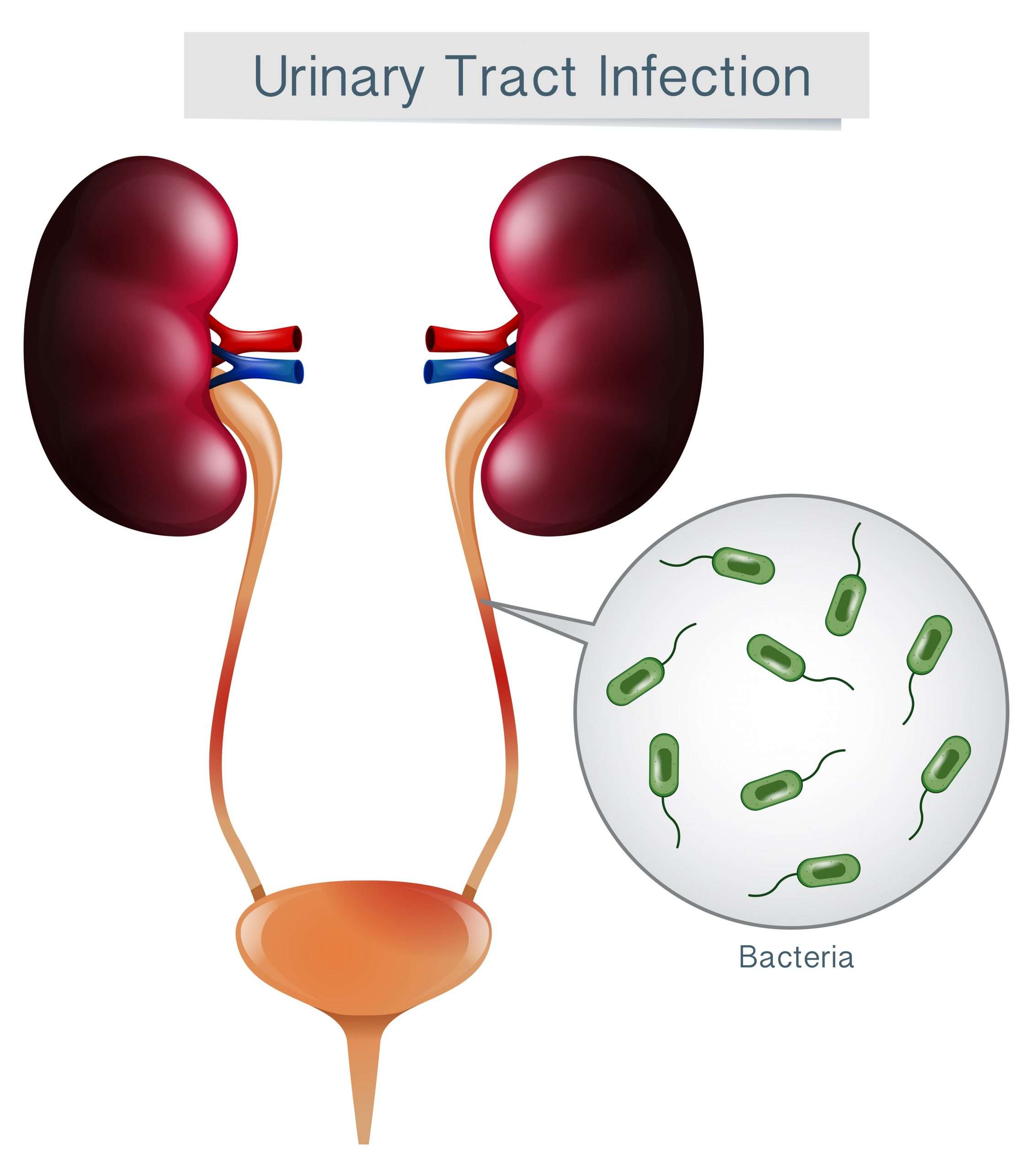 How to a Prevent Urinary Tract Infection in the Elderly ...