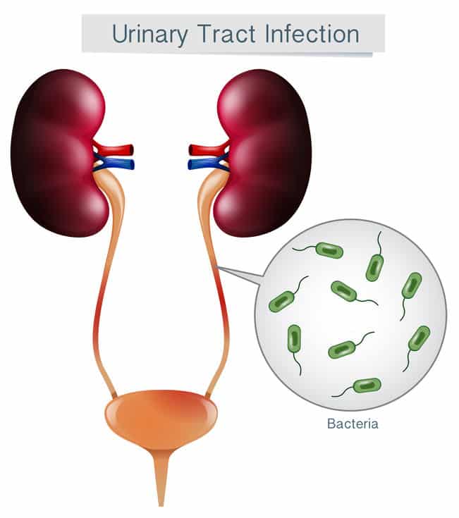 How to Prevent a UTI (Urinary Tract Infection)