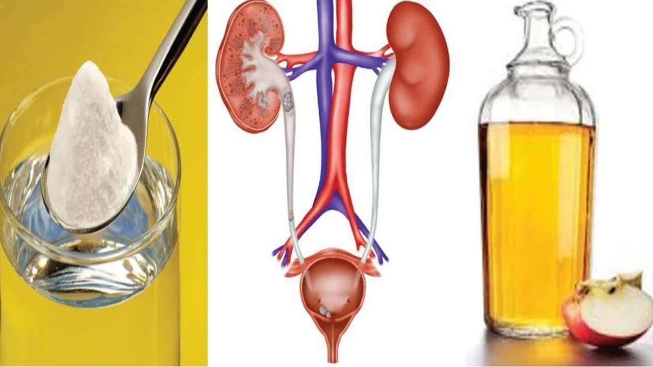 How to Treat a Urinary Tract Infection With ACV And Baking ...