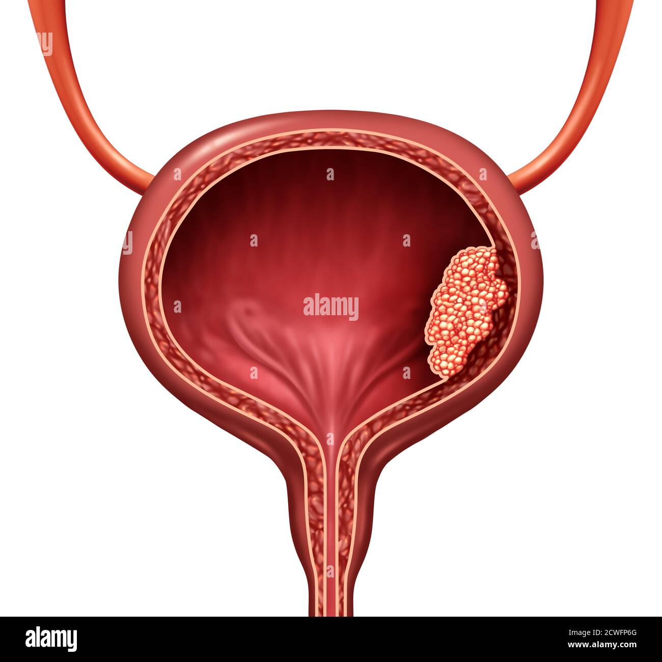 Human bladder cancer as a urinary anatomical organ disease and ...