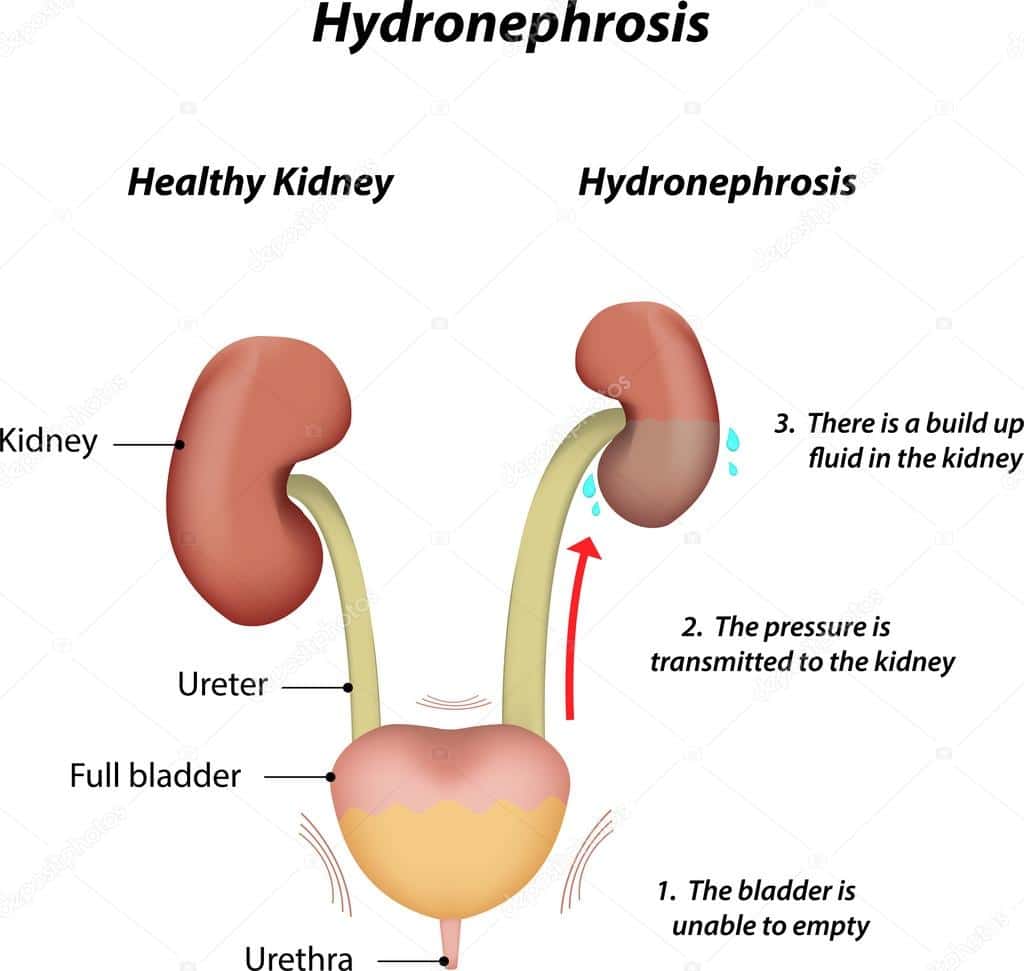 Hydronephrosis, a disease of the renal system  Stock Vector ...