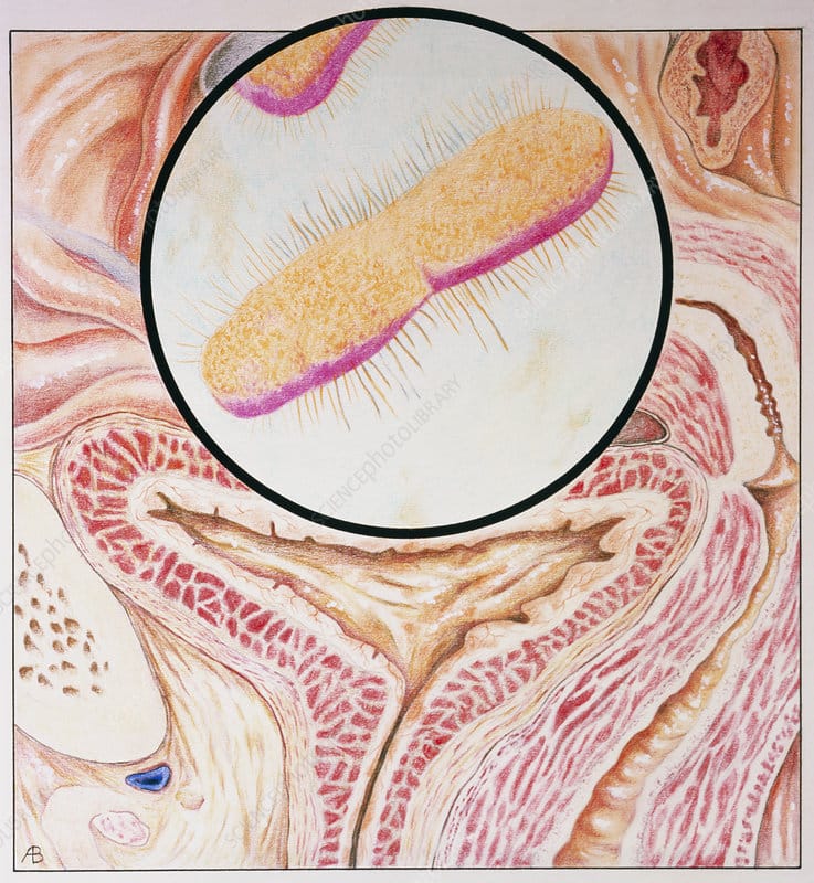 Illustration of cystitis (inflammation of bladder)