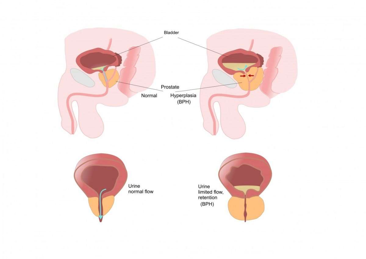 In Benign Prostatic Hyperplasia, Decrease in Oxygen to Tissues Is ...