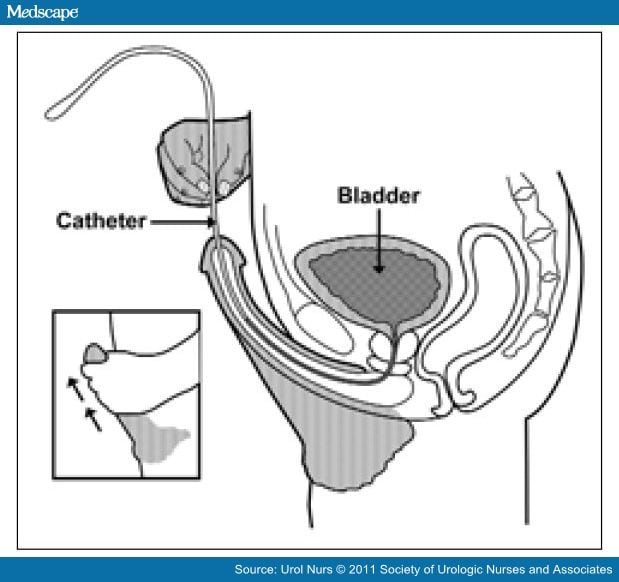 Intermittent Catheterization and Current Best Practices