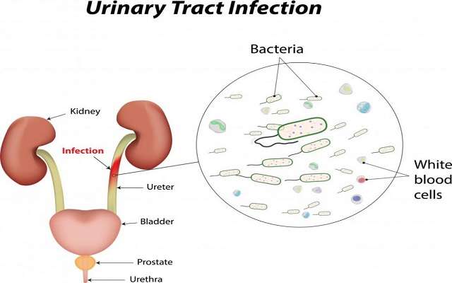 Look At The Signs Of An Urinary Tract Infection And See When Itâs Time ...