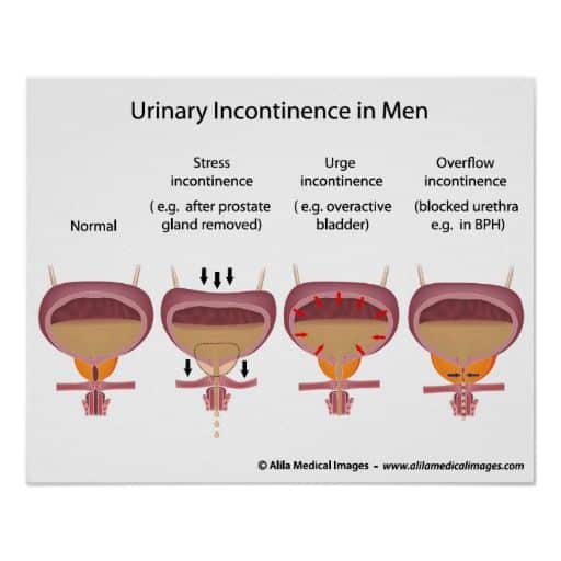 Male urinary incontinence poster