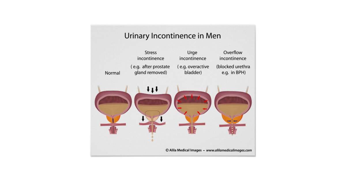 Male urinary incontinence poster