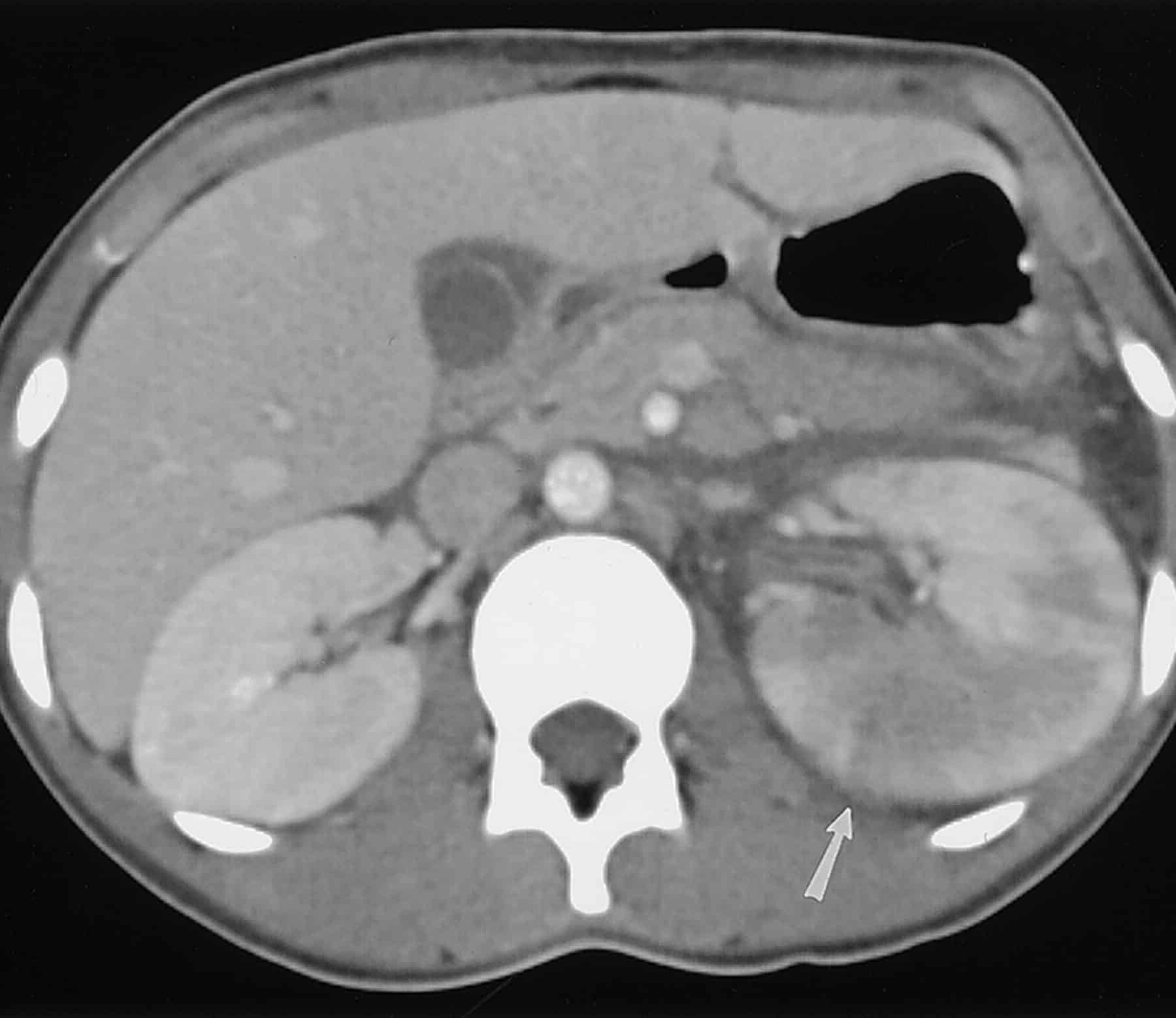 Mimics of Renal Colic: Alternative Diagnoses at Unenhanced Helical CT ...
