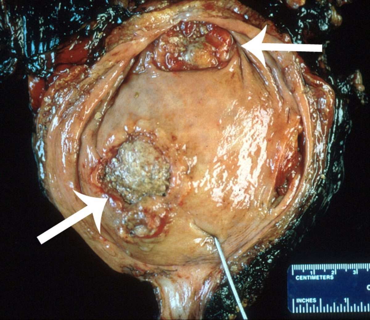 Neoplasms of the Urinary Bladder: Radiologic