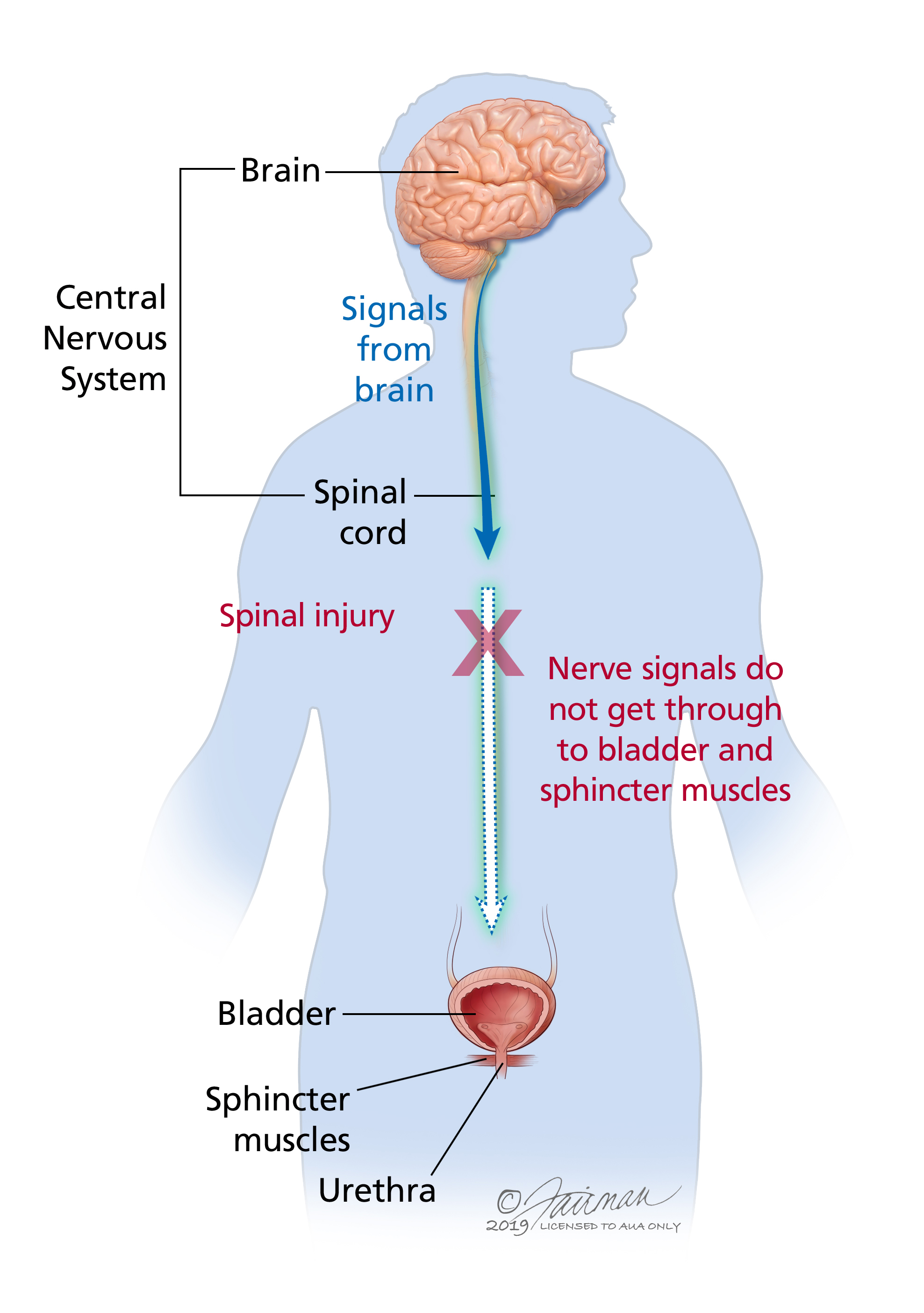 Neurogenic Bladder: Symptoms, Diagnosis &  Treatment