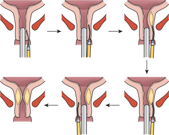 New concept for treating female stress urinary incontinence  Atlas ...