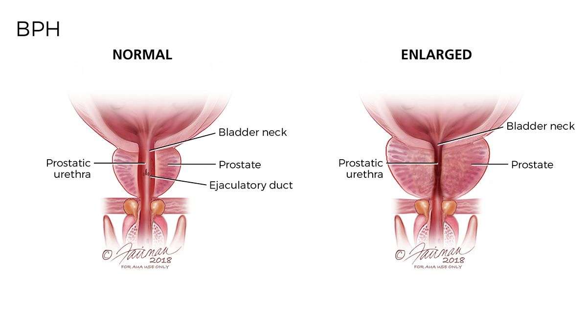 Normal and Enlarged Prostate in 2020