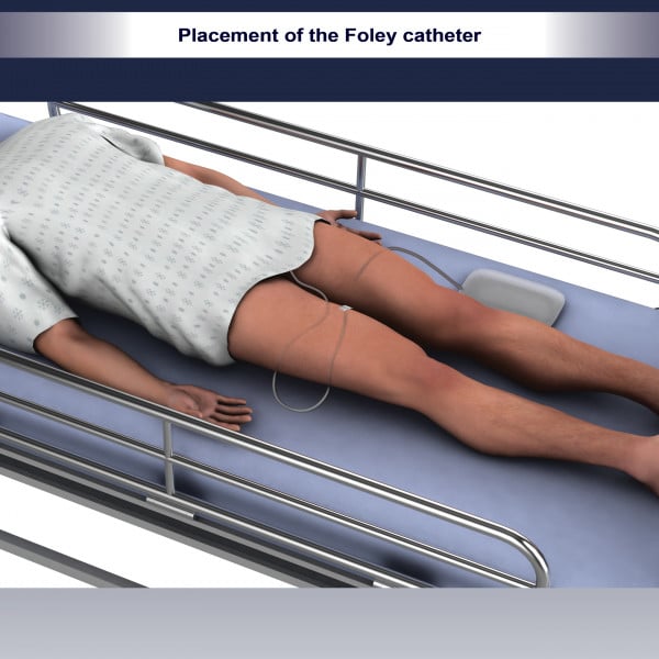 Placement of the Foley catheter