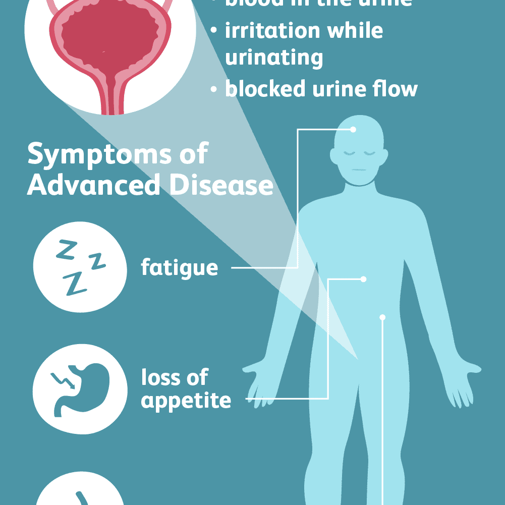 Signs and Symptoms of Bladder Cancer
