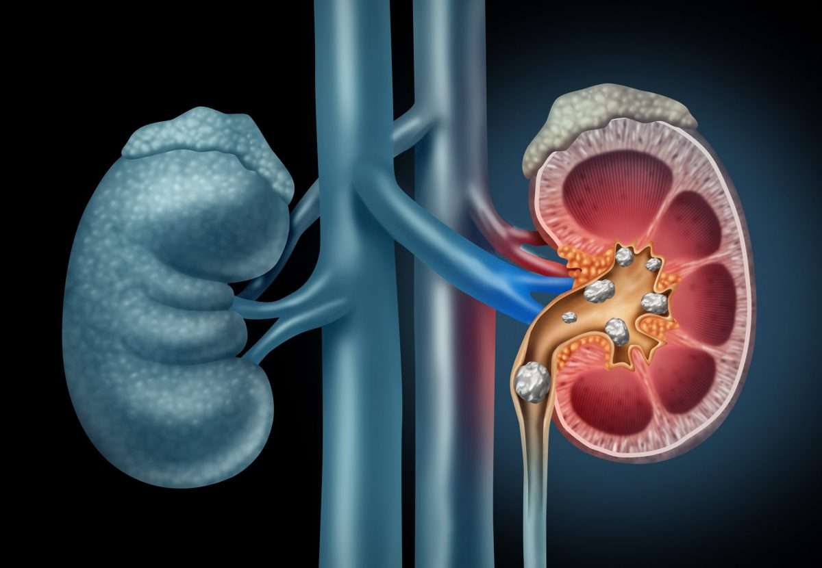 Signs That May Suggest You Have Kidney Stones or Bladder Stones