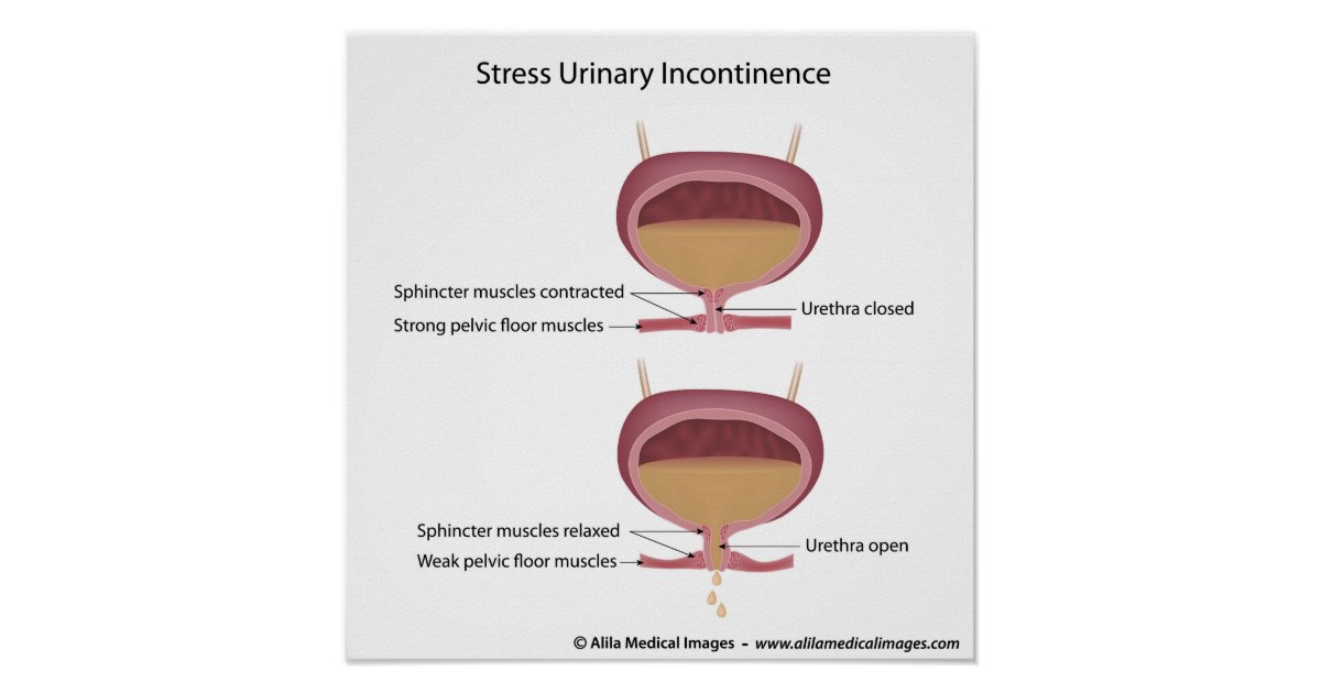 Stress urinary incontinence in women. poster