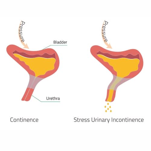 Stress Urinary Incontinence Treatment in Indore