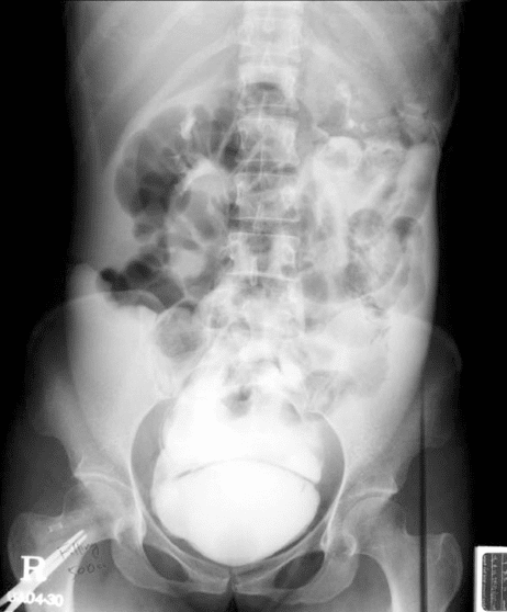 This cystogram shows extravasation of contrast media fr