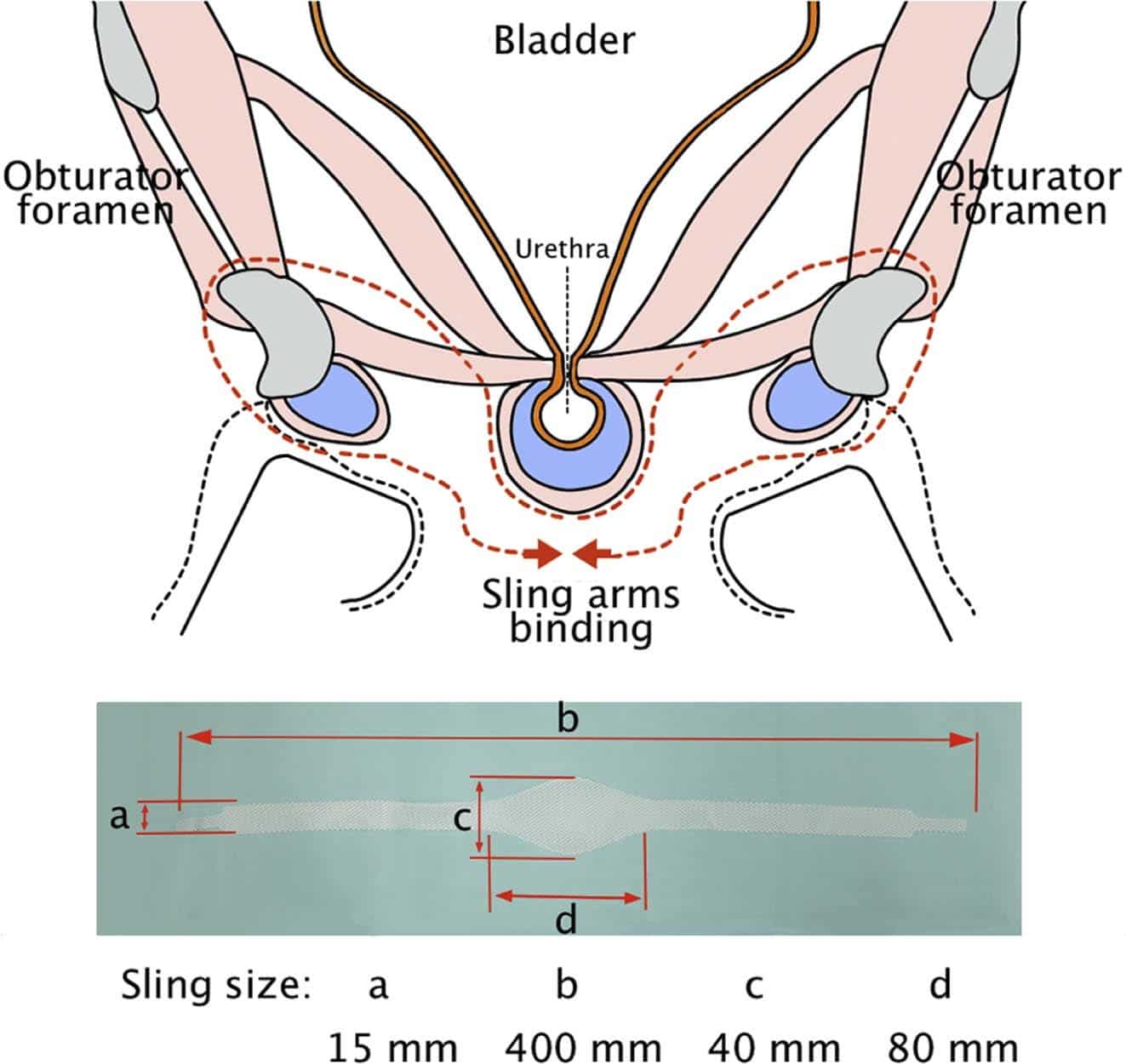 Titanized Transobturator Sling Placement for Male Stress Urinary ...