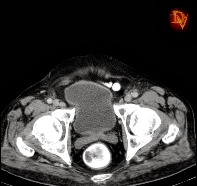 Ultimate Radiology : Urinary Bladder Herniation