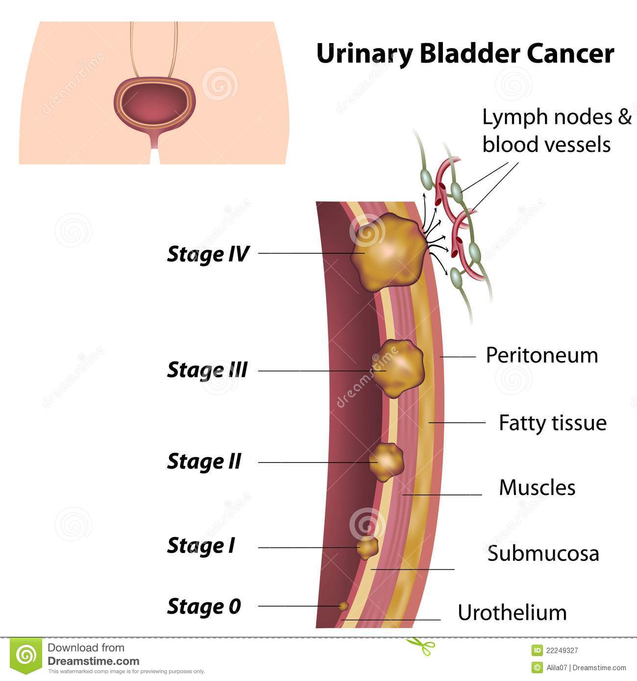 Urinary Bladder Cancer Royalty Free Stock Photography